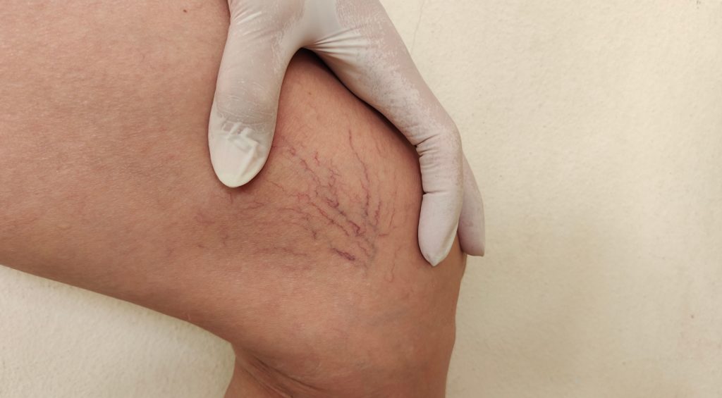 Spider Veins: Why They Appear And How Dermatologists Treat Them